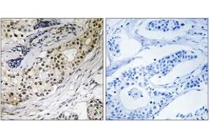 Immunohistochemistry analysis of paraffin-embedded human colon carcinoma tissue, using LAMA3 Antibody. (LAMA3 Antikörper  (AA 2571-2620))