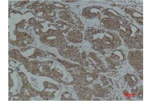 Immunohistochemistry (IHC) analysis of paraffin-embedded Human Breast Carcinoma using Calnexin Polyclonal Antibody. (Calnexin Antikörper)