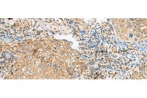 Immunohistochemistry of paraffin-embedded Human cervical cancer tissue using COPE Polyclonal Antibody at dilution of 1:50(x200) (COPE Antikörper)