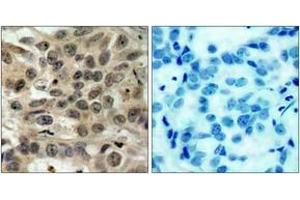 Immunohistochemistry analysis of paraffin-embedded human breast carcinoma tissue, using CDC25C (Ab-216) Antibody. (CDC25C Antikörper  (AA 183-232))