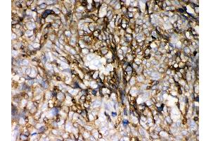 Anti- HLA-C Picoband antibody,IHC(P) IHC(P): Human Lung Cancer Tissue (HLA-C Antikörper  (C-Term))