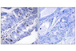 Immunohistochemistry analysis of paraffin-embedded human colon carcinoma tissue using Nuclear Receptor NR4A1 (Phospho-Ser351) antibody. (NR4A1 Antikörper  (pSer351))