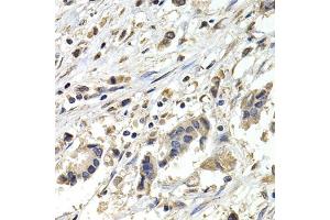 Immunohistochemistry of paraffin-embedded human breast cancer using BUB1B antibody (ABIN5970893) at dilution of 1/200 (40x lens). (BUB1B Antikörper)