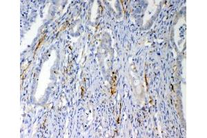 IHC testing of FFPE human colon cancer tissue with VEGFD antibody at 1ug/ml. (VEGFD (VEGF4) (AA 89-205) Antikörper)