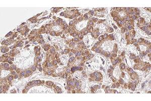 ABIN6279548 at 1/100 staining Human liver cancer tissue by IHC-P. (SLC16A9 Antikörper  (Internal Region))