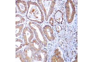 Immunohistochemical analysis of MRPL24 staining in human colon cancer formalin fixed paraffin embedded tissue section. (MRPL24 Antikörper  (Center))