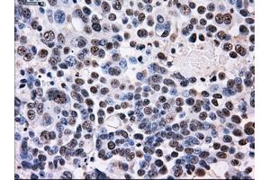 Immunohistochemical staining of paraffin-embedded Adenocarcinoma of colon tissue using anti-ID3mouse monoclonal antibody. (ID3 Antikörper)