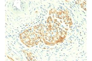 Formalin-fixed, paraffin-embedded human Colon Carcinoma stained with CD56 Rabbit Recombinant Monoclonal Antibody (NCAM1/2217R). (Rekombinanter CD56 Antikörper)