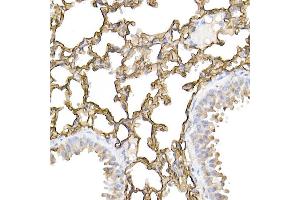 Immunohistochemistry of paraffin-embedded human lung cancer using ICAM-1/CD54 Rabbit pAb (ABIN6129231, ABIN6142118, ABIN6142120 and ABIN6221235) at dilution of 1:100 (40x lens). (ICAM1 Antikörper  (AA 250-480))