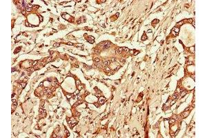 Immunohistochemistry of paraffin-embedded human pancreatic cancer using ABIN7172270 at dilution of 1:100 (TLR3 Antikörper  (AA 135-297))