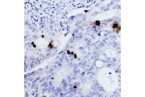 Immunohistochemistry of paraffin-embedded human colon carcinoma using Phospho-Histone H3-S10 Rabbit pAb (ABIN7267687) at dilution of 1:2000 (40x lens). (Histone 3 Antikörper  (H3S10p))