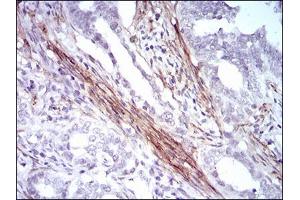 Immunohistochemical analysis of paraffin-embedded cervical cancer tissues using CNN1 mouse mAb with DAB staining. (CNN1 Antikörper  (AA 16-165))