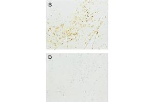 Immunohistochemistry image of acrolein adduct staining in paraffn sections of human atherosclerotic tissue. (ACR-Modified KL Antikörper)