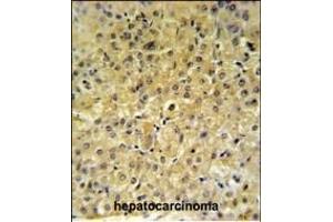 INSC Antibody (Center) (ABIN653657 and ABIN2842997) IHC analysis in formalin fixed and paraffin embedded hepatocarcinoma followed by peroxidase conjugation of the secondary antibody and DAB staining. (INSC Antikörper  (AA 410-437))