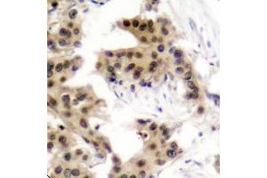Immunohistochemistry of paraffin-embedded human breast carcinoma using Phospho-NFKB1-S893 antibody (ABIN2988205). (NFKB1 Antikörper  (pSer893))
