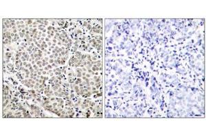 Immunohistochemical analysis of paraffin-embedded human breast carcinoma tissue, using NF-κB p65 (Phospho-Ser529) antibody (E011217). (NF-kB p65 Antikörper  (pSer529))