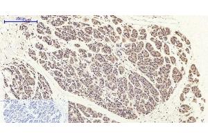 Immunohistochemistry of paraffin-embedded Human stomach cancer tissue with Phospho-FAK (Tyr397) Polyclonal Antibody at dilution of 1:200 (FAK Antikörper  (pTyr397))