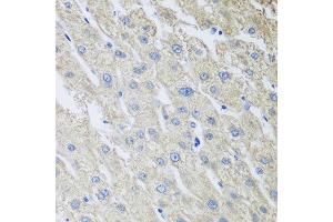 Immunohistochemistry of paraffin-embedded human liver cancer using MLKL antibody at dilution of 1:100 (40x lens). (MLKL Antikörper)