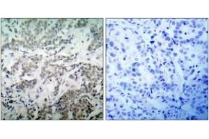 Immunohistochemistry analysis of paraffin-embedded human breast carcinoma tissue, using p53 (Ab-15) Antibody. (p53 Antikörper  (AA 6-55))