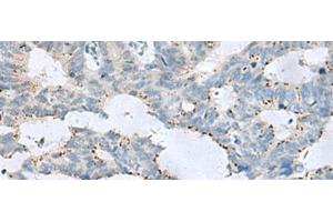 Immunohistochemistry of paraffin-embedded Human colorectal cancer tissue using GPR6 Polyclonal Antibody at dilution of 1:80(x200) (GPR6 Antikörper)