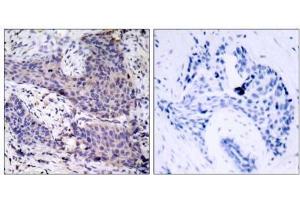 Immunohistochemical analysis of paraffin-embedded human breast carcinoma tissue using BAD (Ab-136) antibody (E021063). (BAD Antikörper)