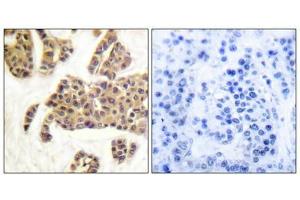 Immunohistochemical analysis of paraffin-embedded human breast carcinoma tissue using BAD (Phospho-Ser91/128) antibody (left)or the same antibody preincubated with blocking peptide (right). (BAD Antikörper  (pSer91, pSer128))