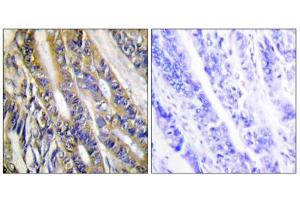 Immunohistochemistry analysis of paraffin-embedded human colon carcinoma tissue, using DGKH antibody. (DGKH Antikörper  (Internal Region))