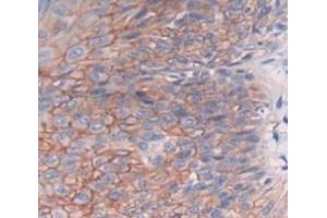 Used in DAB staining on fromalin fixed paraffin- embedded skin cancer tissue (DHODH Antikörper  (AA 35-392))