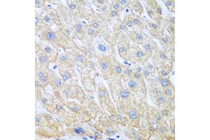 Immunohistochemistry of paraffin-embedded human liver cancer using PTGS1 antibody at dilution of 1:100 (40x lens). (PTGS1 Antikörper)