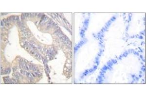 Immunohistochemistry analysis of paraffin-embedded human colon carcinoma tissue, using Gastrin Antibody. (Gastrin Antikörper  (AA 52-101))