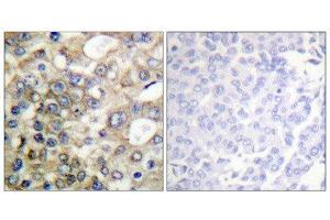 Immunohistochemistry (IHC) image for anti-Mucin 1 (MUC1) (pTyr1229) antibody (ABIN1847433) (MUC1 Antikörper  (pTyr1229))
