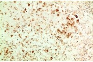 Immunohistochemistry of paraffin-embedded Human ovarian carcinoma tissue using ATG5 Monoclonal Antibody at dilution of 1:200. (ATG5 Antikörper)