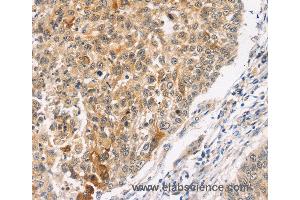 Immunohistochemistry of Human lung cancer using MAPK9 Polyclonal Antibody at dilution of 1:30 (JNK2 Antikörper)