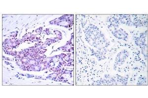 Immunohistochemical analysis of paraffin- embedded human breast carcinoma tissue using NF-κB p65 (Ab-468) antibody (E021013). (NF-kB p65 Antikörper)