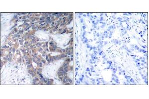 Immunohistochemical analysis of paraffin-embedded human breast carcinoma tissue, using MEK1 (phospho-Ser217) antibody (E011205). (MEK1 Antikörper  (pSer217))