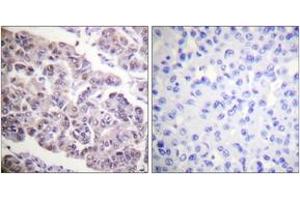 Immunohistochemistry analysis of paraffin-embedded human breast carcinoma tissue, using Histone H4 (Acetyl-Lys12) Antibody. (Histone H4 Antikörper  (acLys12))