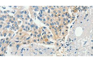 Immunohistochemistry of paraffin-embedded Human breast cancer tissue using DGK beta Polyclonal Antibody at dilution 1:60 (DGKB Antikörper)