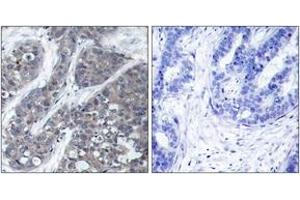 Immunohistochemistry analysis of paraffin-embedded human breast carcinoma tissue, using PYK2 (Ab-402) Antibody. (PTK2B Antikörper  (AA 369-418))