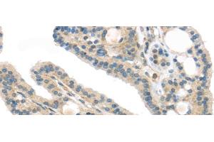 Immunohistochemistry of paraffin-embedded Human thyroid cancer using VPS26A Polyclonal Antibody at dilution of 1/40 (VPS26A Antikörper)