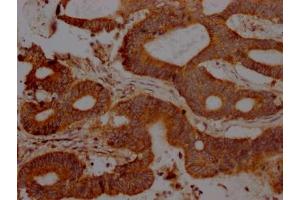 IHC image of ABIN7127483 diluted at 1:100 and staining in paraffin-embedded human colon cancer performed on a Leica BondTM system. (Rekombinanter FAS Antikörper)