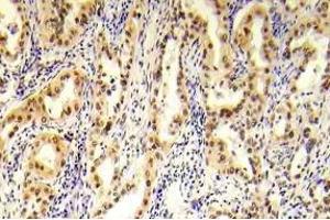 Immunohistochemistry (IHC) analyzes of p-Tsc2 antibody in paraffin-embedded human prostate carcinoma tissue. (Tuberin Antikörper  (pSer1254))