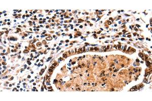 Immunohistochemistry of paraffin-embedded Human stomach cancer tissue using DNMT3A Polyclonal Antibody at dilution 1:65 (DNMT3A Antikörper)