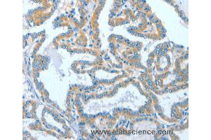 Immunohistochemistry of Human colon cancer using ASCC1 Polyclonal Antibody at dilution of 1:50 (ASCC1 Antikörper)