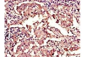 Immunohistochemistry of paraffin-embedded human lung cancer using ABIN7157854 at dilution of 1:100 (Lamin B1 Antikörper  (AA 385-552))