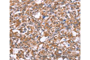 Immunohistochemistry of Human gastric cancer using GPC6 Polyclonal Antibody at dilution of 1:40 (Glypican 6 Antikörper)