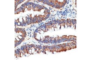 Immunohistochemistry of paraffin-embedded human colon carcinoma using P Rabbit mAb (ABIN1682842, ABIN3019312, ABIN3019313 and ABIN7101749) at dilution of 1:100 (40x lens). (PAWR Antikörper)