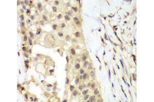 Immunohistochemistry of paraffin-embedded Human lung cancer using FGFR1 Polyclonal Antibody at dilution of 1:100 (40x lens). (FGFR1 Antikörper)