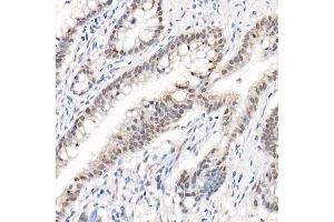 Immunohistochemistry of paraffin-embedded human colon carcinoma using Phospho--S473 Rabbit pAb (ABIN1513328, ABIN5664973, ABIN5664975 and ABIN6225474) at dilution of 1:50 (40x lens). (AKT1 Antikörper  (pSer473))