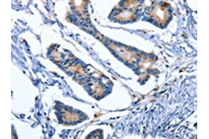 The image on the left is immunohistochemistry of paraffin-embedded Human colon cancer tissue using ABIN7191031(IBSP Antibody) at dilution 1/50, on the right is treated with synthetic peptide. (IBSP Antikörper)