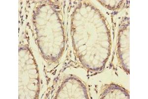 Immunohistochemistry of paraffin-embedded human colon cancer using ABIN7166047 at dilution of 1:100 (S1A14 (AA 1-104) Antikörper)